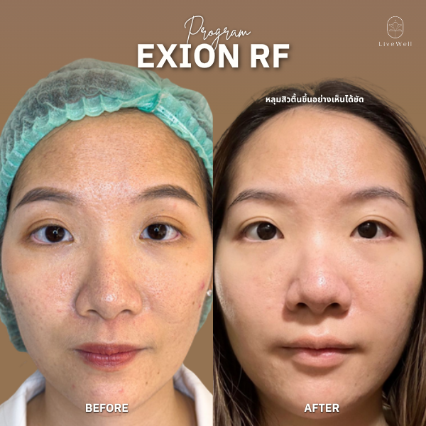 รีวิว EXION RF