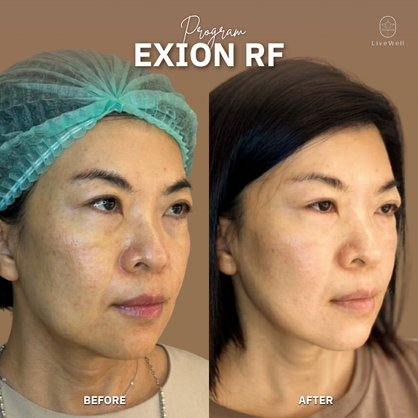 รีวิว EXION RF