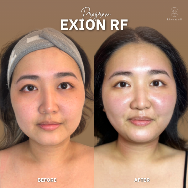 รีวิว EXION RF