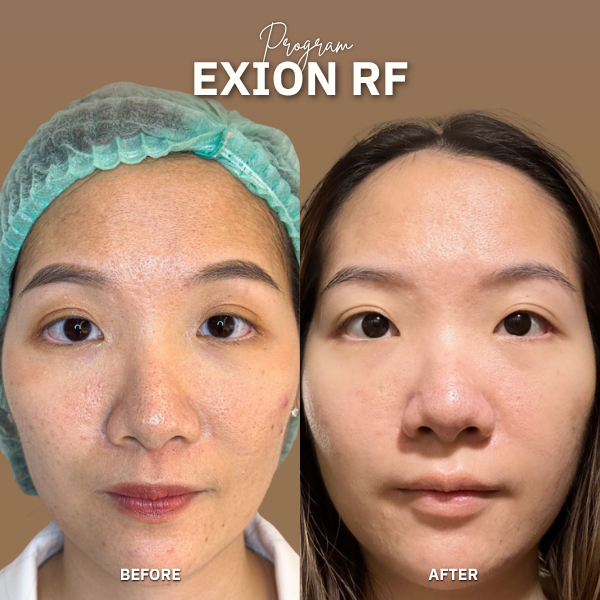 EXION RF
