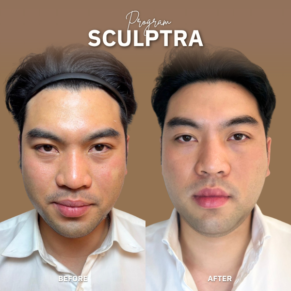 Sculptra