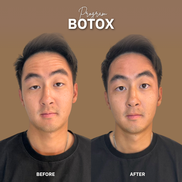 Botox