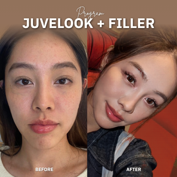 Juvelook Filler